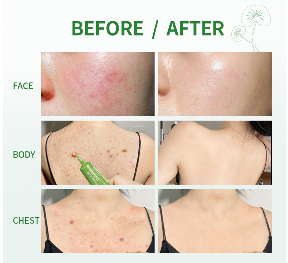 Crema Antiacné Facial – Tratamiento Efectivo para Piel con Imperfecciones