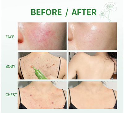 Crema Antiacné Facial – Tratamiento Efectivo para Piel con Imperfecciones